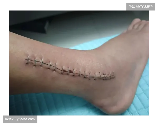 马竞前锋瑟洛特右前额外侧挫裂伤，伤口缝合后恢复中